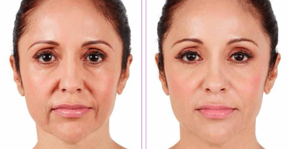 Dermal Fillers in Pittsburgh | Vujevich Dermatology Associates