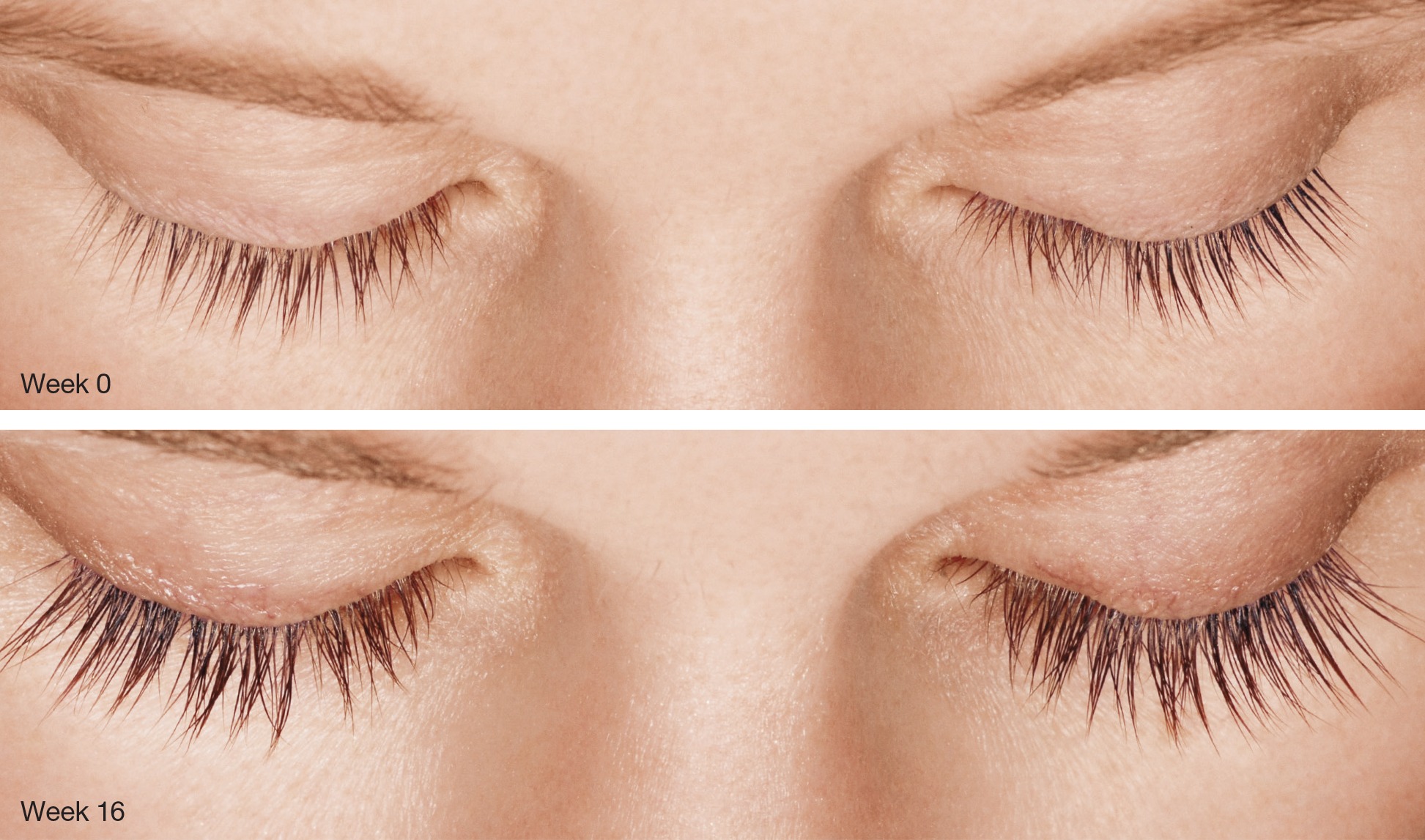 latisse treatment.