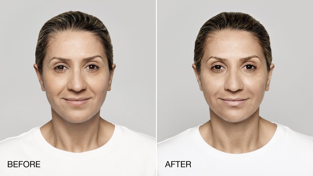 dermal fillers in pittsburgh before and after