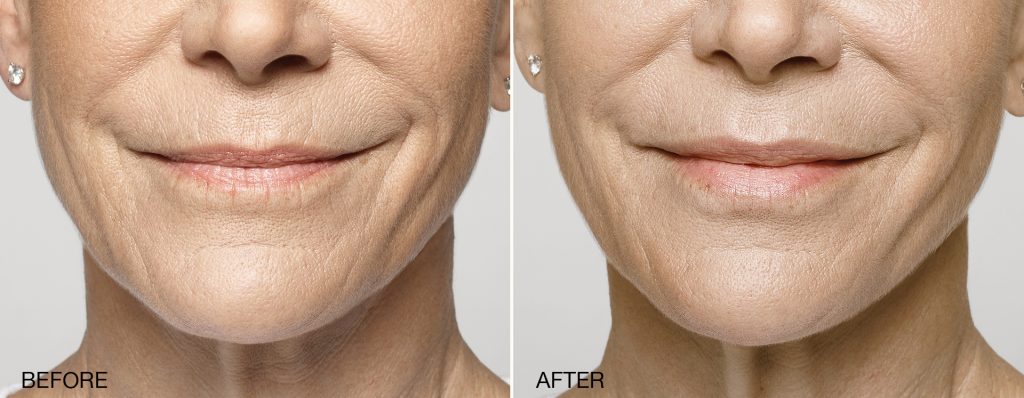 dermal fillers in pittsburgh