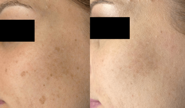 laser skin treatment