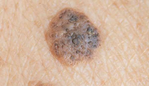 seborrheic keratosis vs melanoma