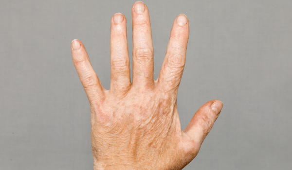 vitiligo treatment