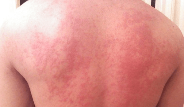 hives symptoms