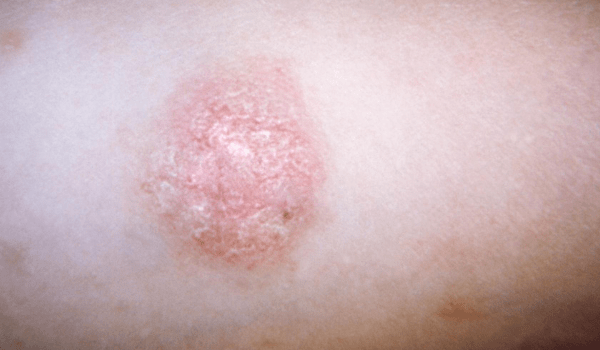 Herald Patch and Pityriasis Rosea | Vujevich Dermatology