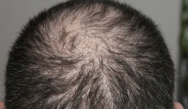 alopecia treatment