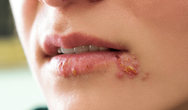 fever-blister-vs-cold-sore