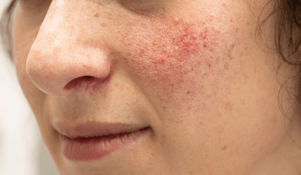 rosacea treatment