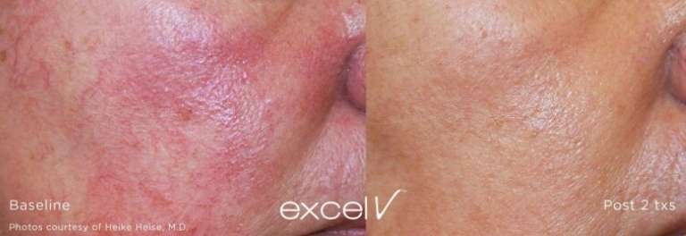 before and after image of laser skin treatment with excel v laser for rosacea to treat blood vessels