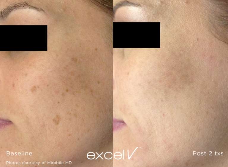 before and after image of laser skin treatment with excel v laser to treat sunspots