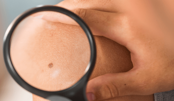 dermatologic surgeon examining mole