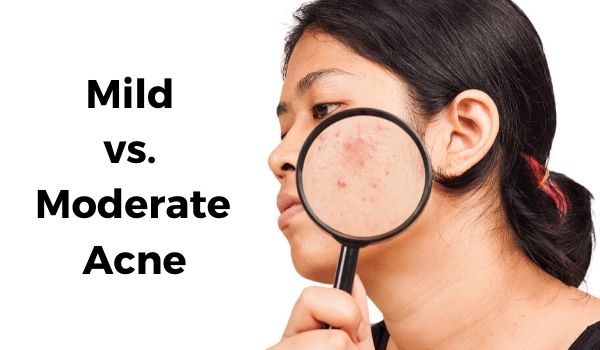 mild vs moderate acne
