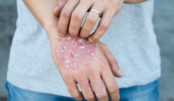 what is psoriasis