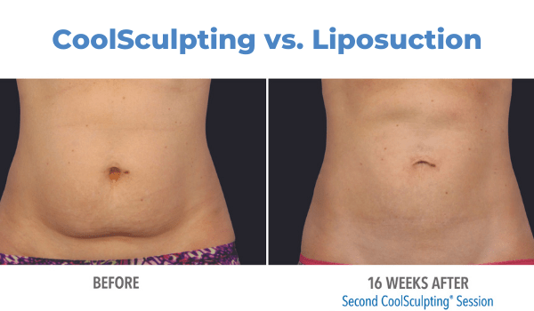 CoolSculpting vs liposuction