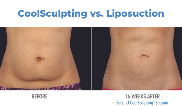 Coolsculpting Vs Liposuction Vujevich