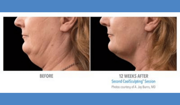 Coolsculpting for the chin before and after