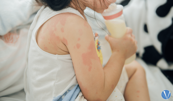 skin allergies in kids