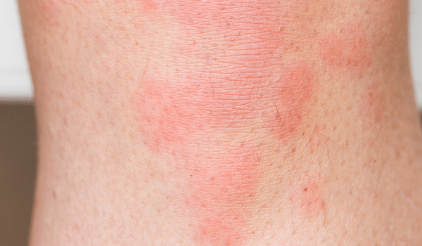chronic hives causes, treatment, and how to find relief