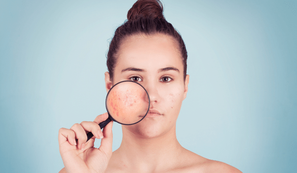 moderate acne treatment guide