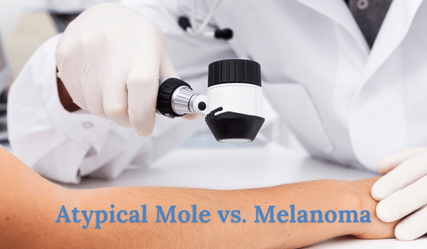 atypical mole vs melanoma - what you should know