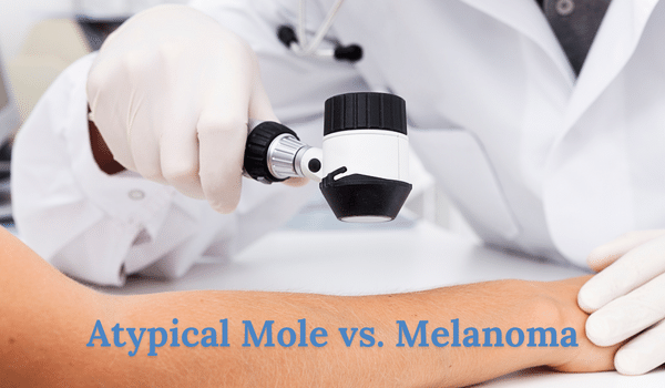 cancerous moles vs normal moles