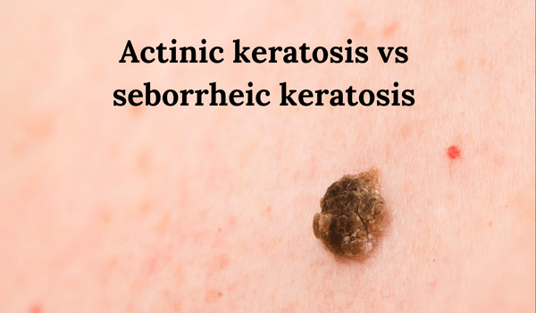 actinic keratosis vs seborrheic keratosis vujevich dermatology blog