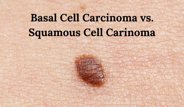 basal cell carcinoma vs squamous cell carcinoma