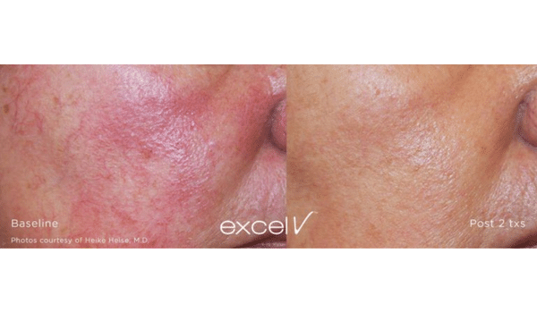 Best for Redness | Vujevich Dermatology Associates