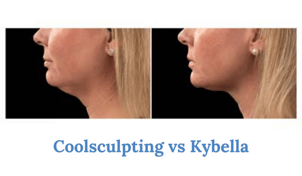 coolsculpting vs kybella for the chin and neck areas