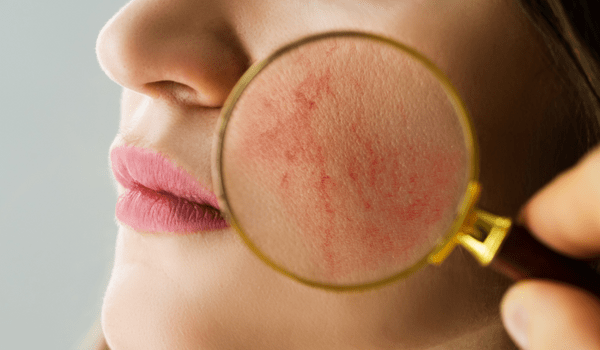 ris Håbefuld vulkansk 3 Reasons for Red Patches on Your Face | Vujevich Dermatology