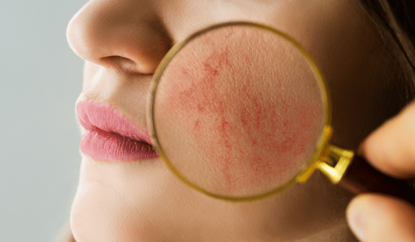 3 Reasons for Red Patches on Your Face