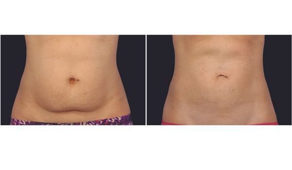 non surgical fat removal from stomach: coolsculpting