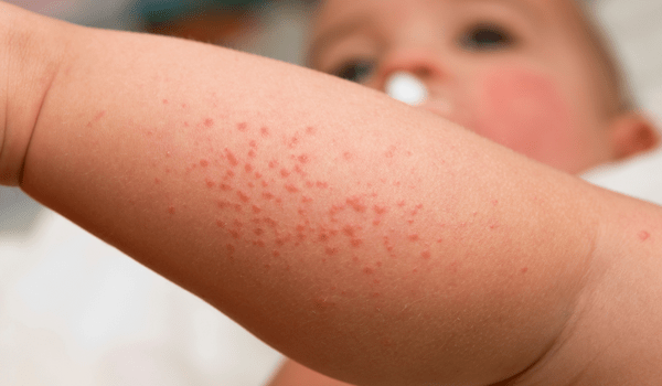 spots on toddler - how to identify them