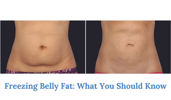 freezing belly fat: what you should know about coolsculpting