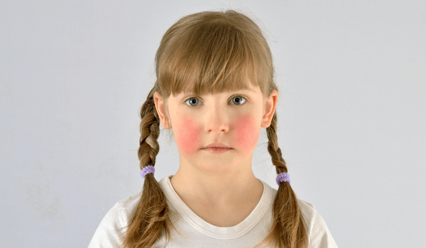 what causes red cheeks in a child