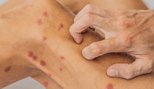 What Causes Itching Red Spots on the Whole Skin?  