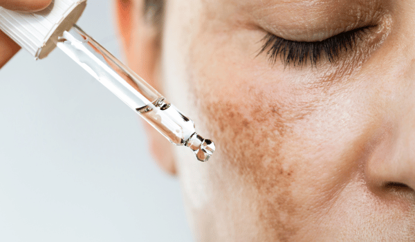 dark patches on cheeks - melasma and hyperpigmentation