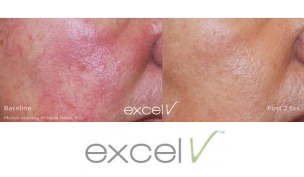 laser treatment for the face - vujevich dermatology excel v laser