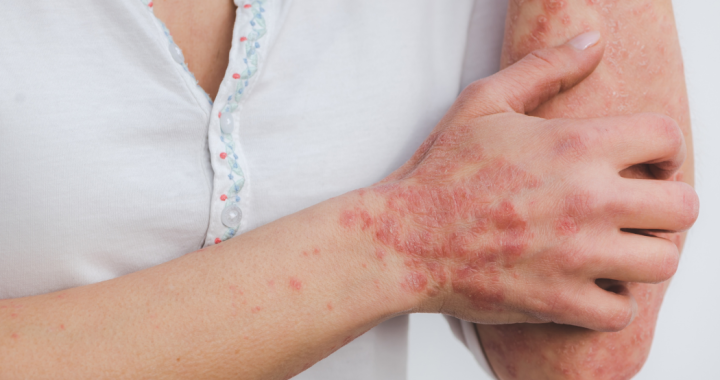 causes of psoriasis