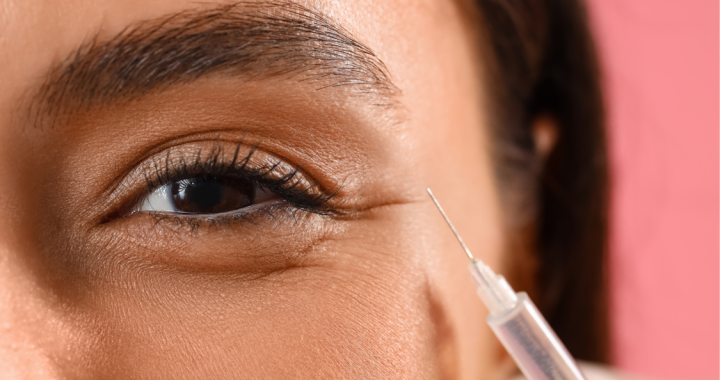 dermal fillers under eyes