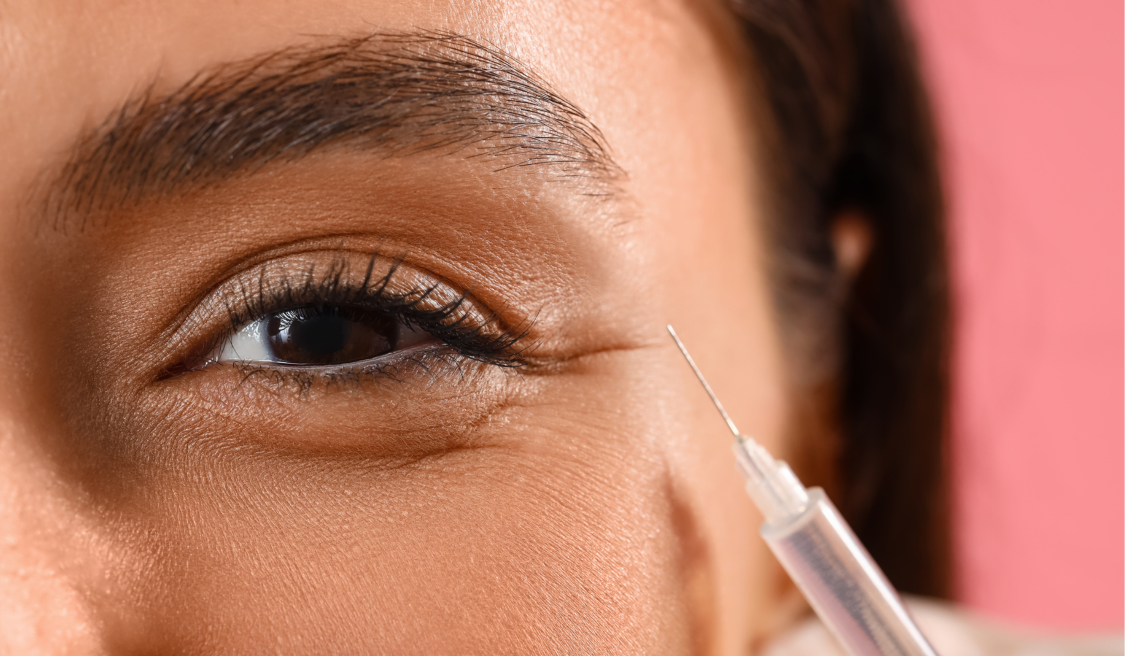 Dermal Fillers Under Your Eyes | Vujevich Dermatology