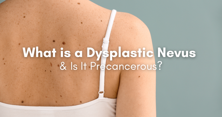 dysplastic nevus