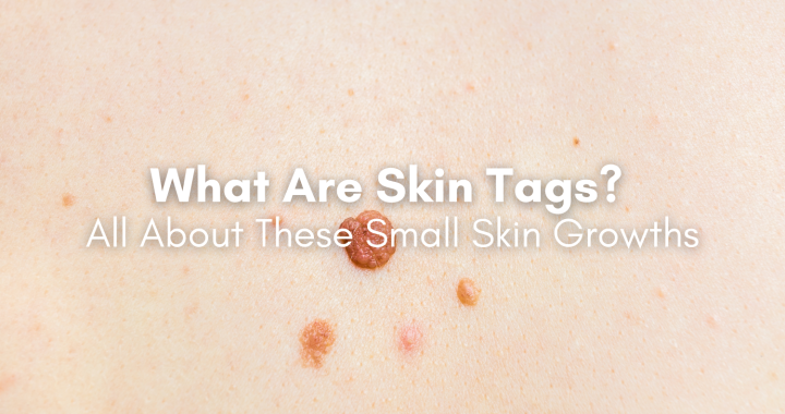 what are skin tags