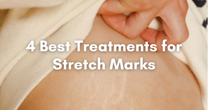 best treatment for stretch marks