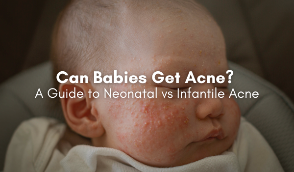 neonatal acne vs infantile acne guide