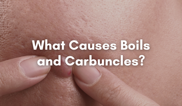 what causes boils on the skin