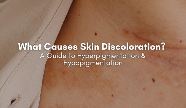 What causes skin discoloration? A guide to hyperpigmentation and hypopigmentation.