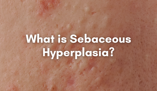 sebaceous hyperplasia treatment